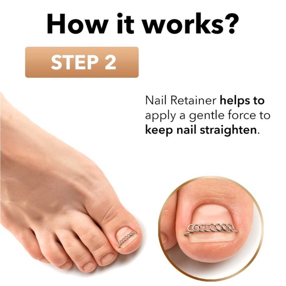 Dr. Krause Ingrown Toenail Treatment Tool Kit (partial amt. of items) - Picture 6 of 7